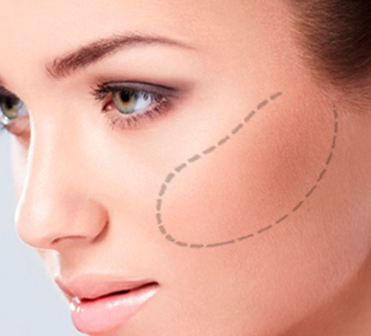 implantes-faciales